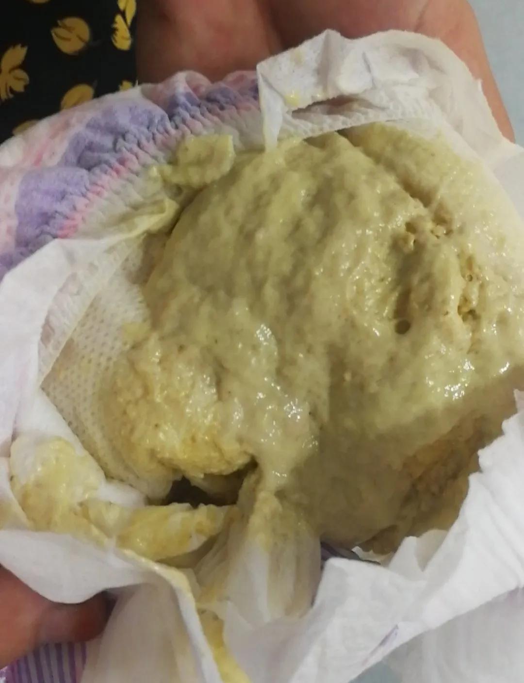 早产儿满月黄疸还没退怎么办,宝宝满月了黄疸还没退怎么办