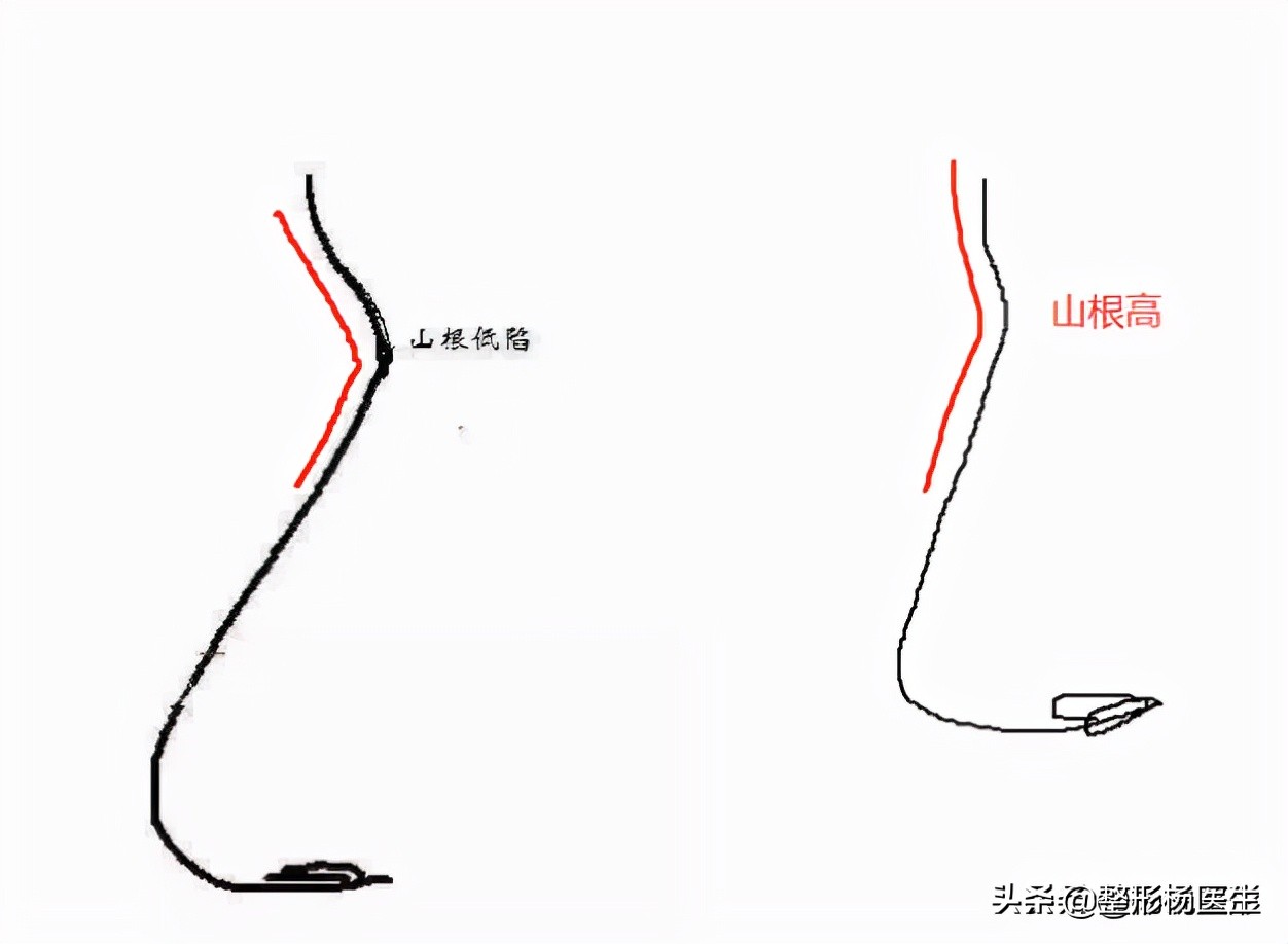 隆鼻失败的常见原因有哪些,隆鼻失败最快的解决方法