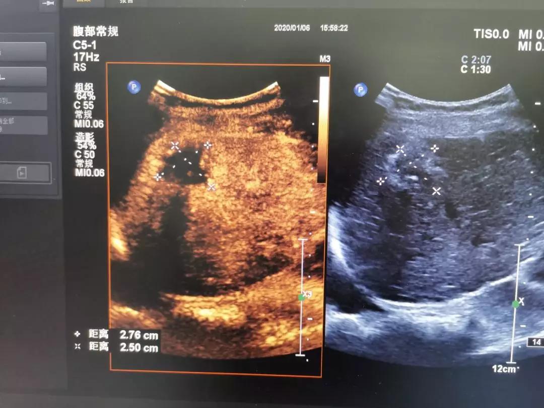 陕西中医药大学超声医学,射频消融术对肝癌治疗的疗效