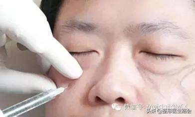 填了泪沟眼睛淤青很厉害,填完泪沟8个月了还淤青怎么办