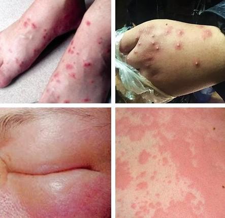 防止毒虫叮咬的最好方法,毒虫叮咬后的救命方法