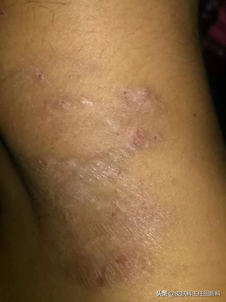 真菌感染性皮肤病原因,人真菌皮肤病怎么治