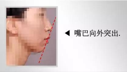 隆下巴后,整张脸都会变美了