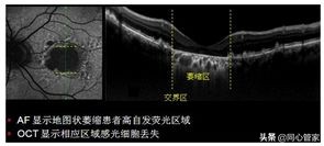 造影如何判断是血栓还是斑块,斑块和血栓ct区别