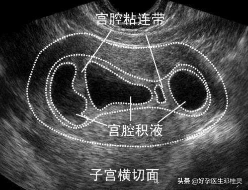 人流后痛经量少一定是宫腔粘连吗,人流后宫腔粘连吃中药会来月经吗