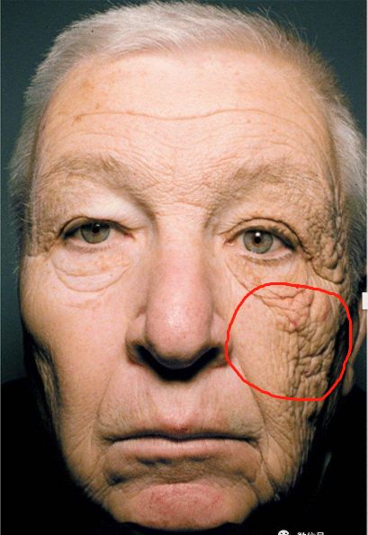 你们的痘痘最后都是怎么完全好的？反正我是用了这个方法才好的