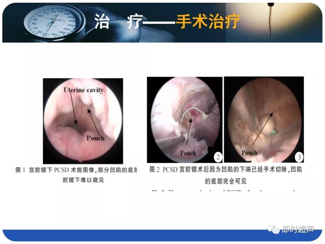 孕妇剖宫产瘢痕憩室,剖宫产瘢痕憩室息肉