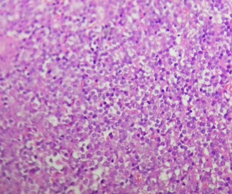 罕见肿瘤中医治疗案例视频,罕见肿瘤中医治疗案例