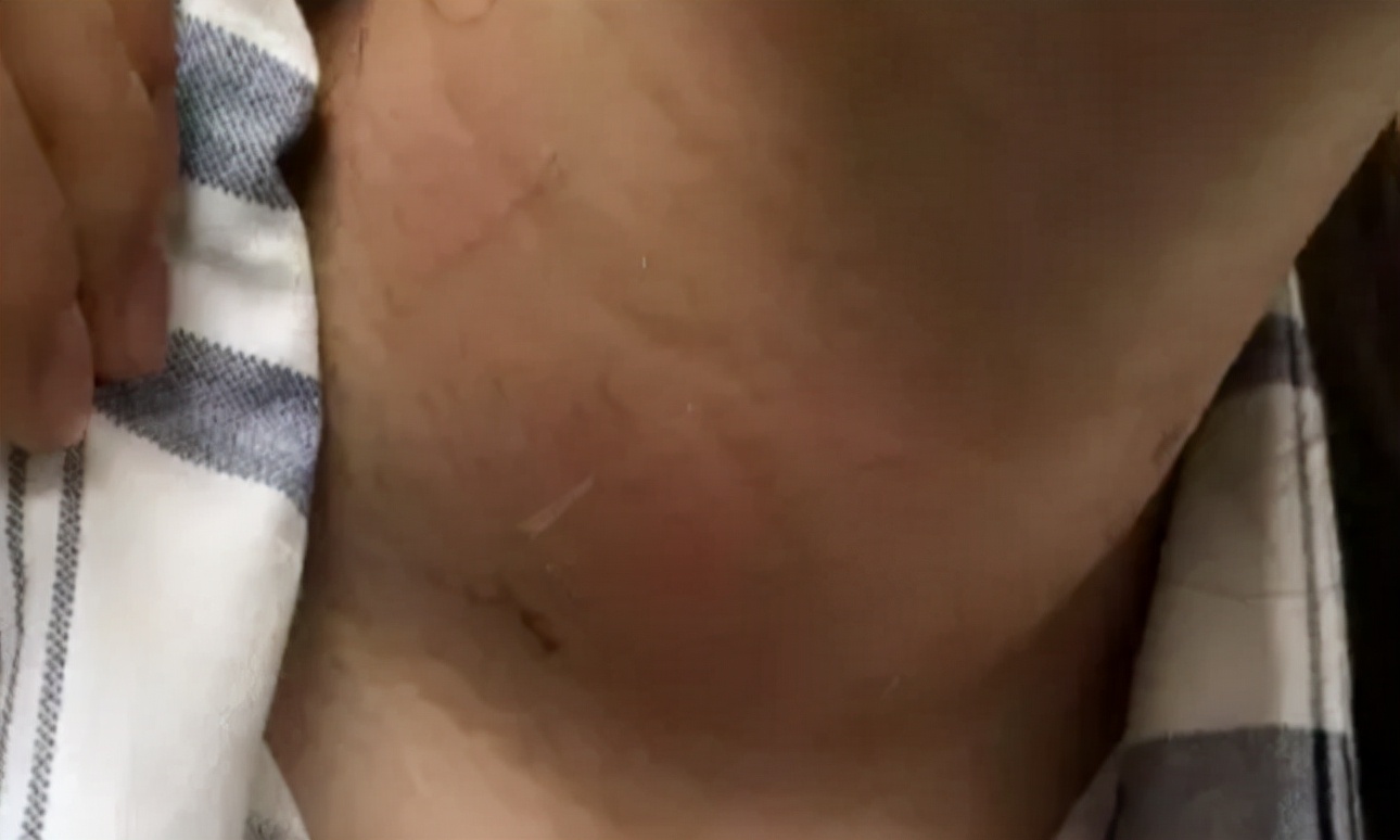 发现甲亢疾病时，要尽早治疗，早日远离疾病的伤害