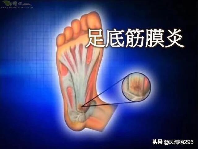 预防足底筋膜炎动作,足底跖筋膜炎症状及治疗