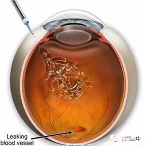 年龄相关性黄斑变性辅助检查,年龄相关性黄斑变性