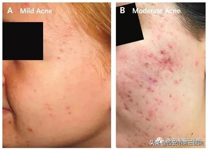 脸上全是痘真正有效的办法,脸上长小痘痘不疼不痒是什么痘