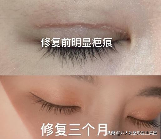 平行式双眼皮变成普通窄双眼皮了,悲伤蛙双眼皮图片