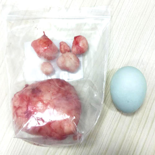 女人子宫没了,和正常人有什么区别?哪些疾病要进行子宫切除?