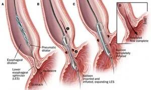 贲门紧缩术能彻底治愈食管反流吗,巴雷特食管能做贲门紧缩术吗