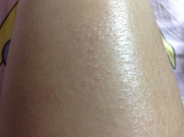 身上布满“蛇皮”？不做这样的“蛇蝎美人”！