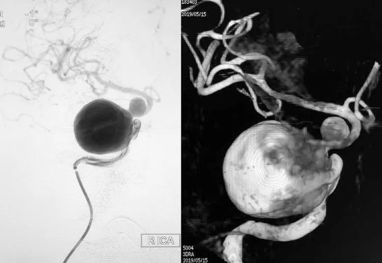 国外怎么治疗动脉瘤,全世界颅内动脉瘤最佳的治疗