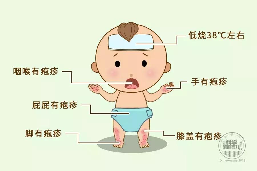 手足口喝利巴韦林管用吗,利巴韦林可以治手足口吗