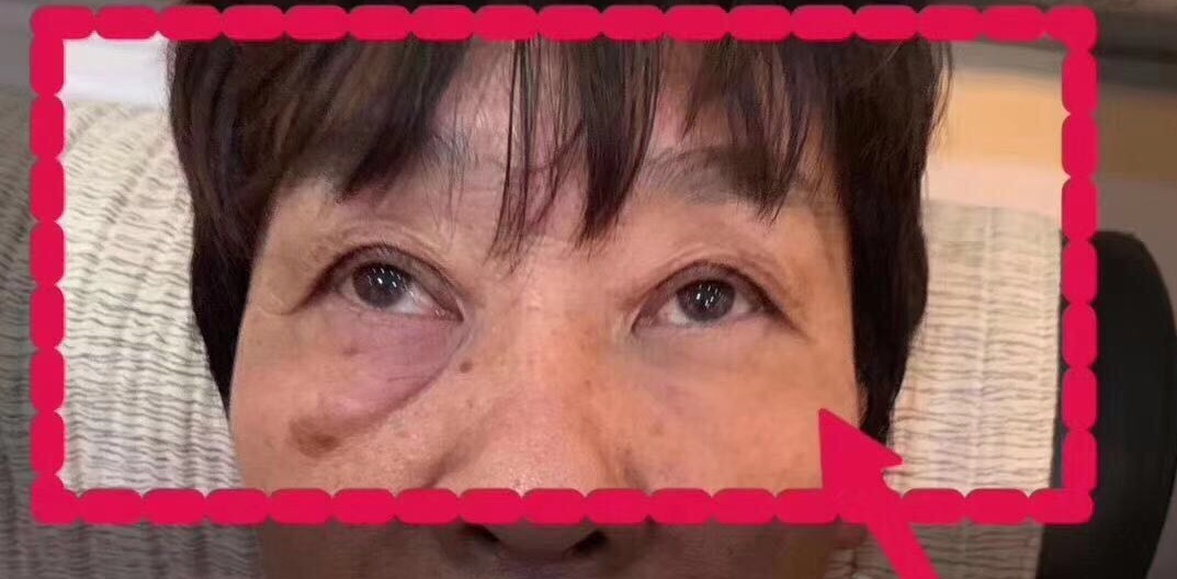 眼袋救星来了,医生推荐眼袋救星