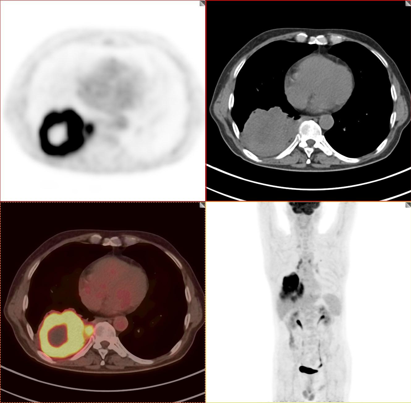 petct肺癌晚期必须要做吗,肺癌患者petct