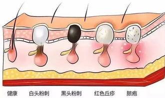 清洁脸部男士毛孔粗大,脸部毛孔粗大如何改善有黑头