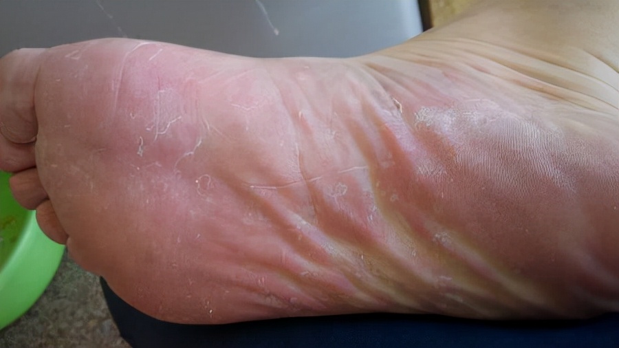 脚痒一直好不了是怎么回事,脚痒很多年了一直没治好