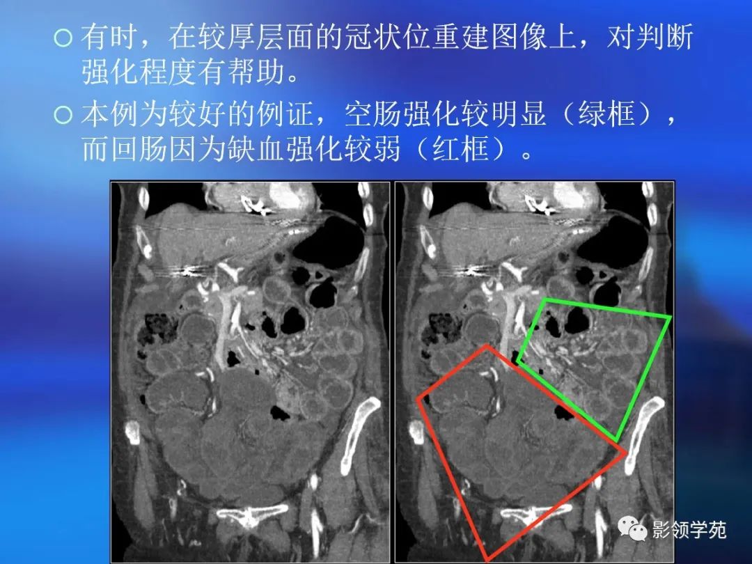 肠道内壁增厚,肠道扩张ct表现