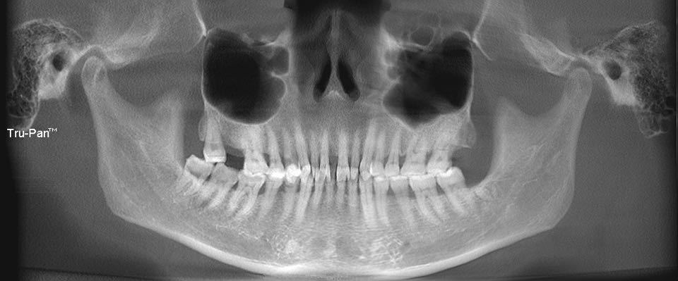 杨磊正畸医生,牙周病牙龈萎缩正畸案例