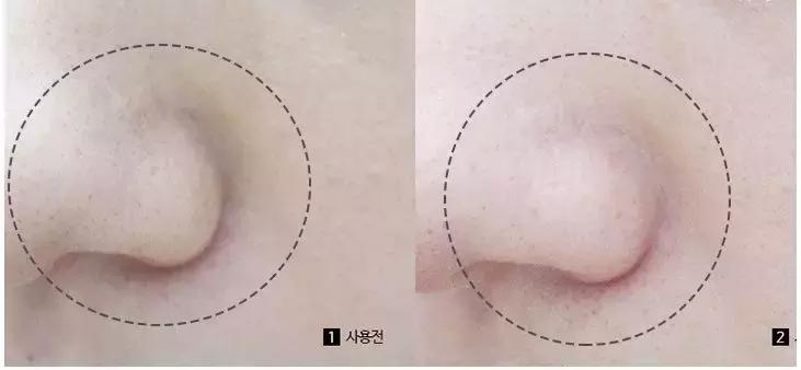 洗脸清洗黑头,洗脸清洁去粉刺