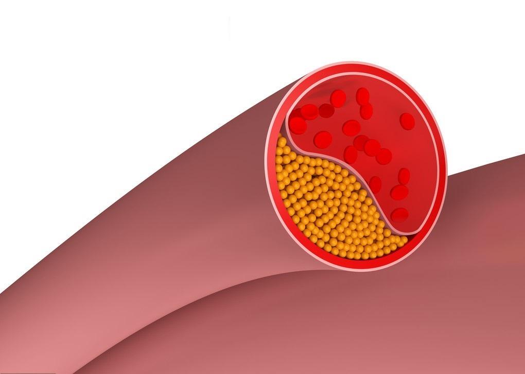 动脉粥样硬化斑块吃哪种他汀最好,他汀类药物对于动脉斑块有作用吗