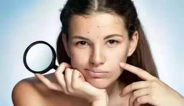 轻松解决你的五大问题,轻松祛痘方法推荐