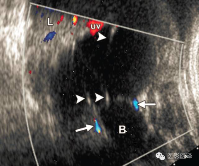 胎儿卵巢囊肿5.6厘米会消失吗,卵巢巨大囊肿与妊娠鉴别