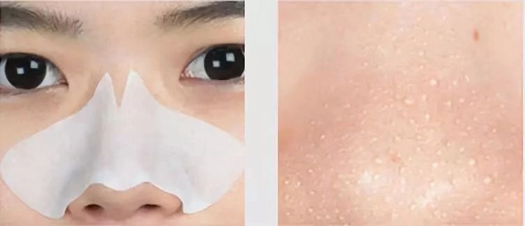 一秒去黑头去粉刺,一步就能搞定的黑头