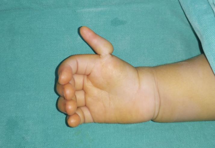 漂浮拇:成功保五指|案例2《半掌骨移植重建术让小女孩“重生”》