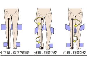 儿童膝外翻足内翻同时出现,儿童膝内翻