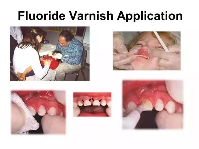 蛀牙下的牙龈有白色的小白点,牙齿有白斑是龋齿的前兆吗