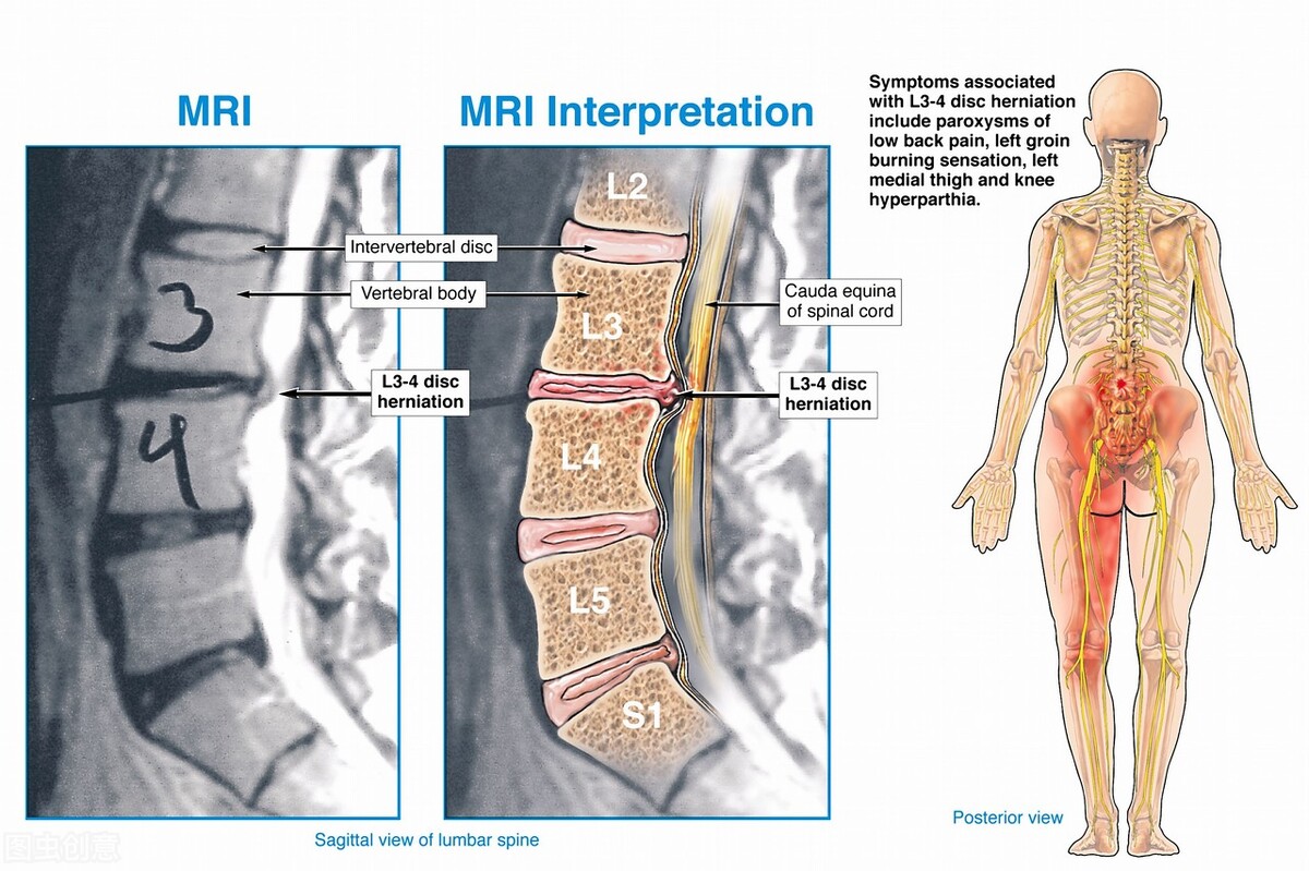 腰椎间盘突出打臭氧针属于微创吗,腰椎间盘突出臭氧还是射频效果好