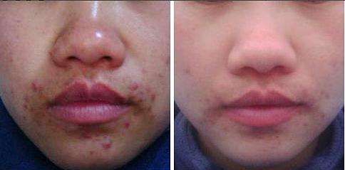 博乐达真的好用吗,博乐达使用前后对比