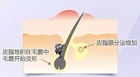 痘痘不去挤变疤痕疙瘩,痘痘不去挤变黑了怎么办