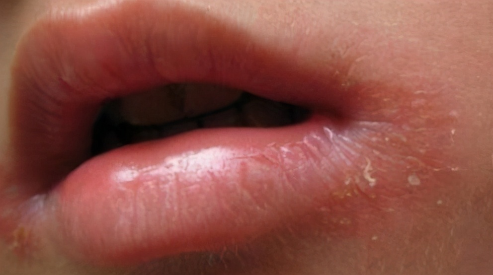 烂嘴角最快的解决办法,吃腊肉上火烂嘴角是什么原理