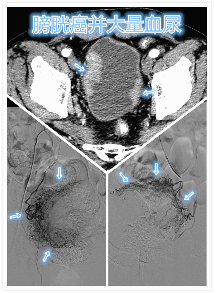 膀胱癌出现大量血尿怎么办吧？