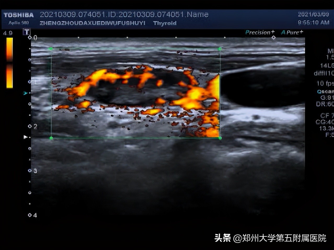 小小淋巴细胞,淋巴结有很多小小的会影响生命吗