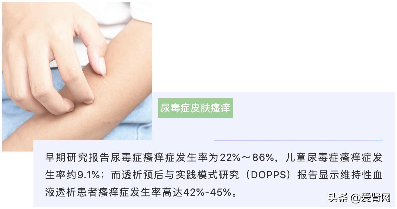 肾友如何应对皮肤瘙痒,肾引起的皮肤痒怎么办