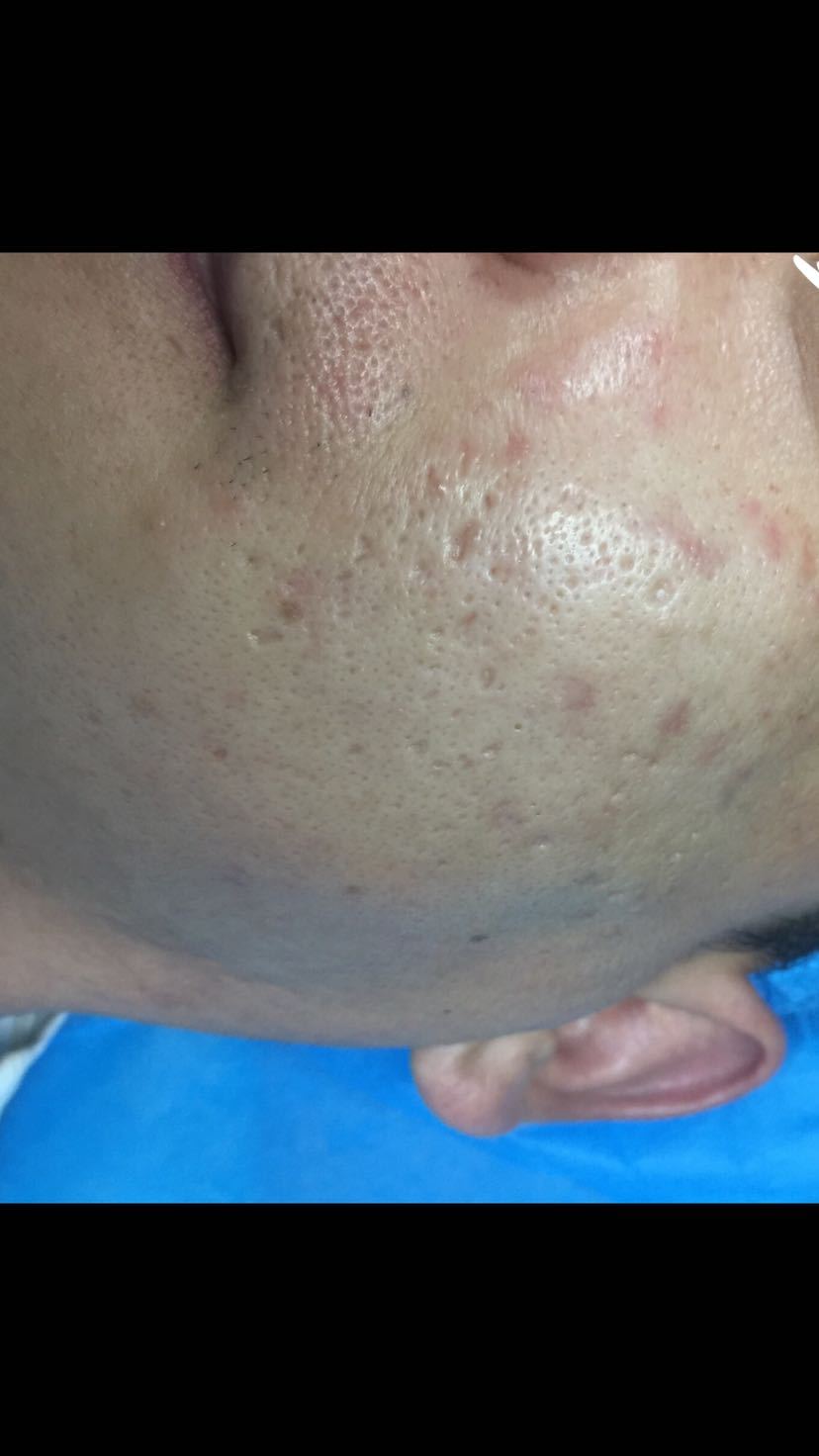 疮的最佳治疗方法用什么药,痔疮的中成药有哪些