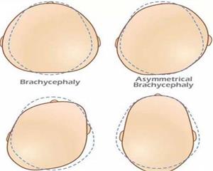 顺产挤压头部变形影响智力吗,顺产时怎样避免胎儿头部变形