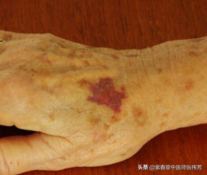 老年人手臂上长紫色斑块,老年色素性紫癜全身发痒怎样治疗