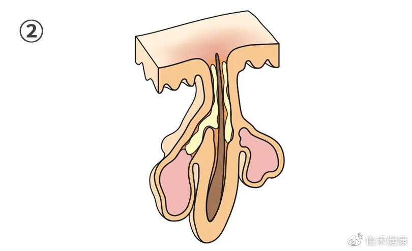 你以为的黑头真的是黑头吗,讨厌的黑头真的会变成草莓鼻吗
