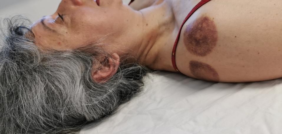 肩周炎六经,肩周炎经筋疗法图解