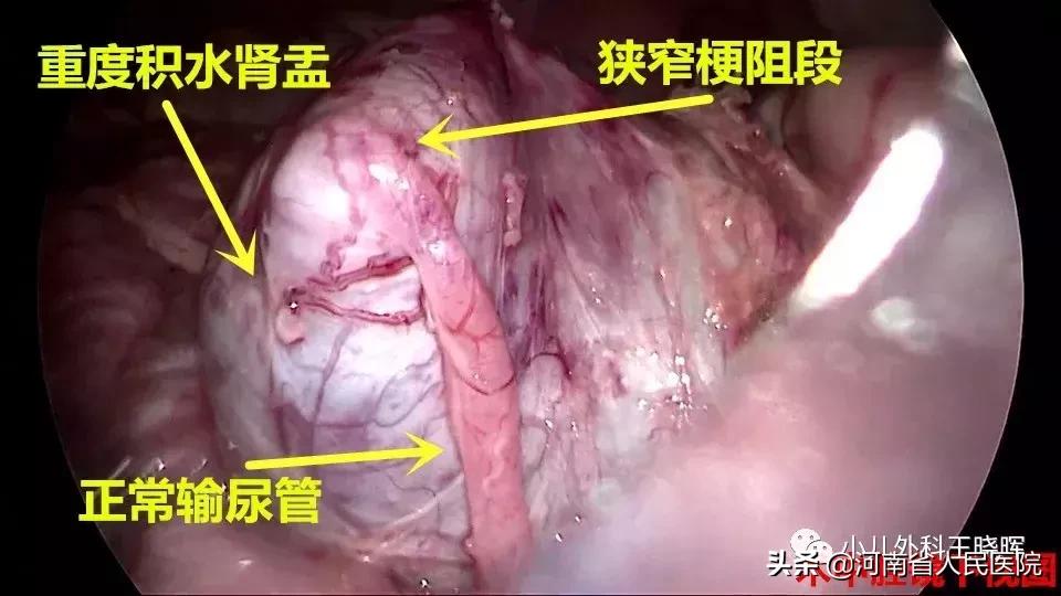 肾积水手术需要插几天尿管,宝宝重度肾积水