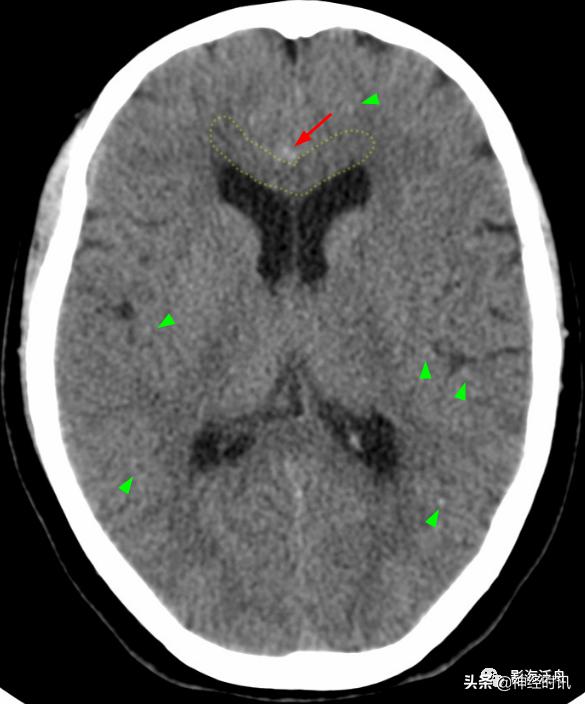 蛛血的临床表现,蛛血ct表现
